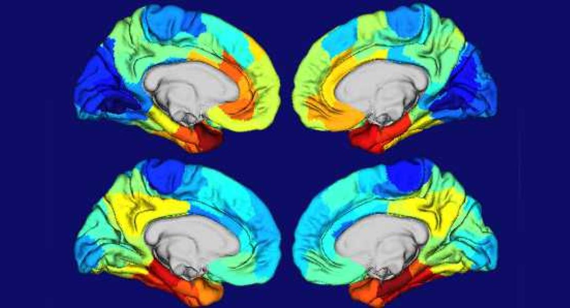 Motivo per cui l'Alzheimer danneggia parti del cervello