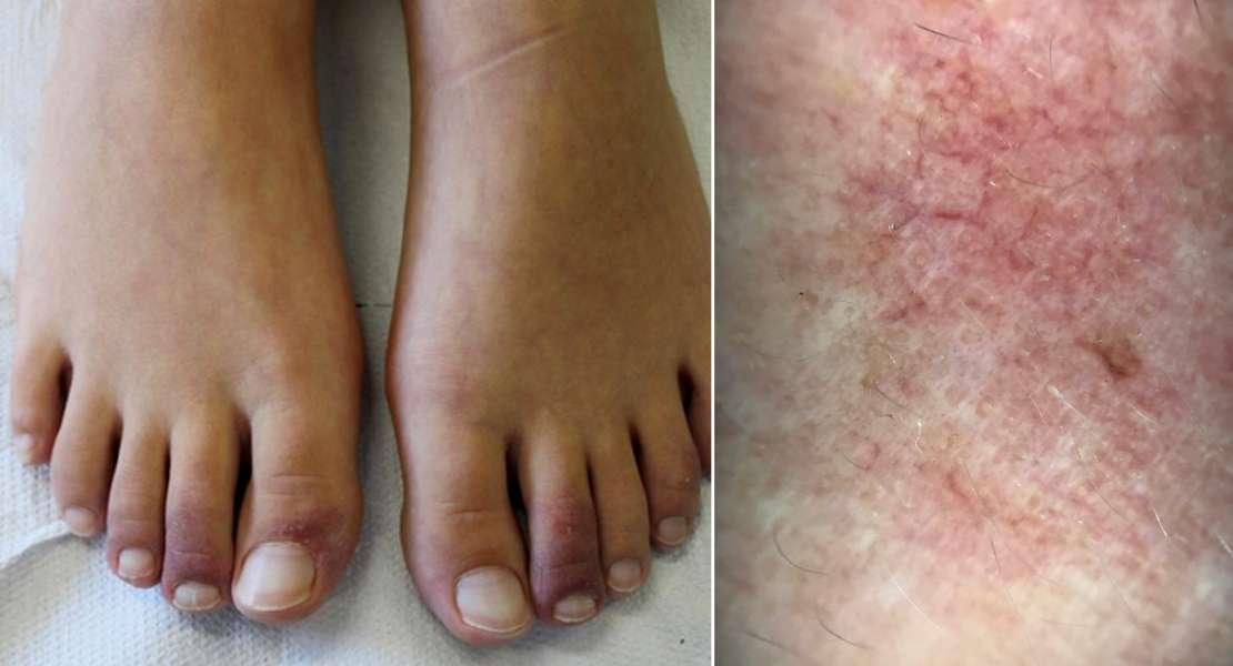 Gelone e Rosacea