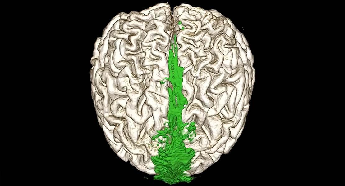Come il cervello elimina i propri scarti
