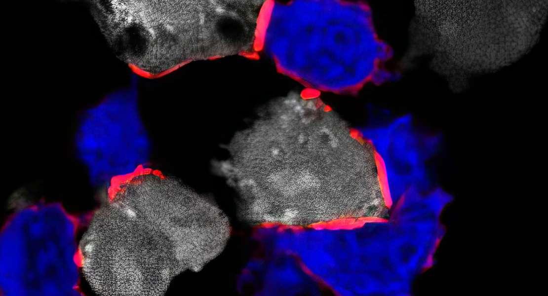 Le cellule T (blu) che attaccano le cellule tumorali