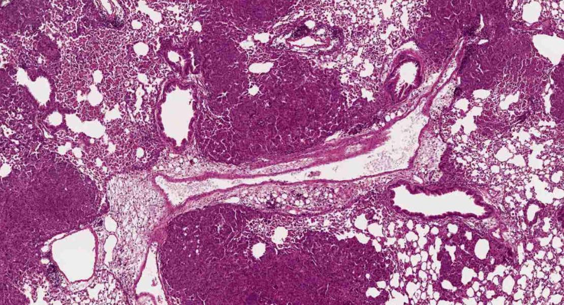 Cancro polmonare MMRd