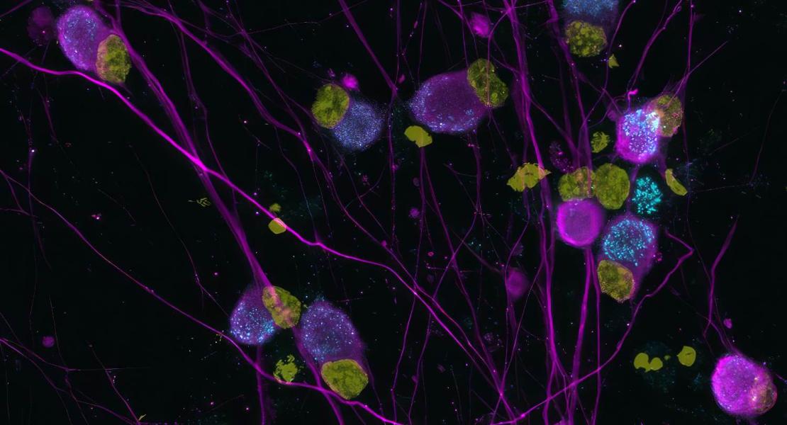 Neuroni sensoriali umani indotti con il canale ionico Elkin1 (ciano), nucleo (giallo) e Neurofilamento 200 (magenta).