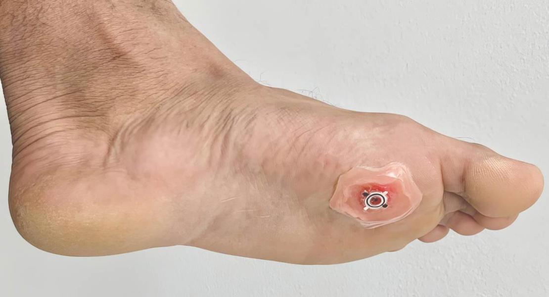 Foto di WPED applicata su una ferita fittizia su un piede umano.