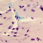 Porphyromonas gingivalis